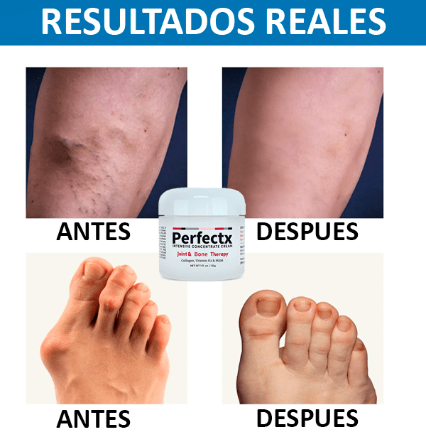 Perfectx™ Terapia Articular Y Muscular